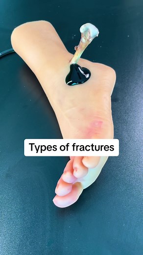 First Aid: Types of Fractures & How to Splint a Broken Bone