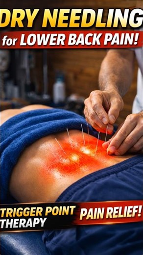 Dry Needling Therapy for Lower Back Pain Lumbar Trigger Point Treatment#physiotherapist #painrelief