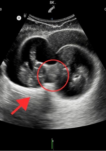 Lors de l’échographie de ma grossesse gémellaire, le médecin s’est figé, fixant l’écran. Puis, d’une voix calme, il a dit quelque chose qui m’a glacé le sang — des mots qui ont tout changé. Julia était mère de six enfants, déjà expérimentée, mais rien ne l’avait préparée à ce qui allait se passer pendant sa septième grossesse 💭. Elle et son nouveau mari, Alexander, étaient ravis — des jumeaux ! Ou du moins, c’est ce qu’ils pensaient. Le jour de l’échographie, Julia était allongée sur la table, 