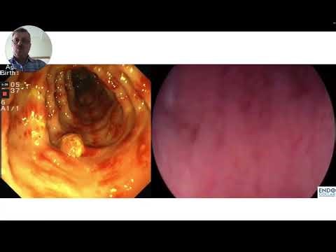 Endoscopic Findings: Watermelon Colon & Pseudopolyps