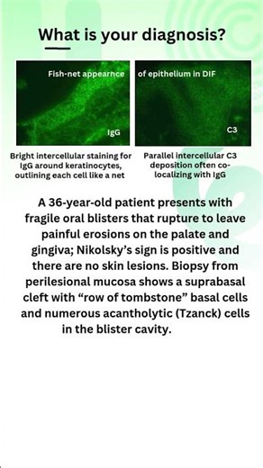 Fish-net appearance of intercellular IgG and C3 on DIF #oralpathology #pemphigus #ihc