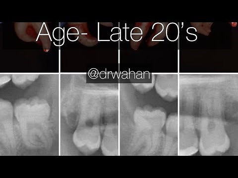 Third Molar Extractions with Curved Roots in an Older Patient