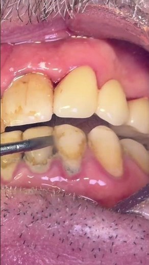 Deep Scaling Transformation | Satisfying Dental ASMR