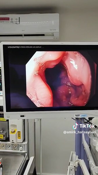 Serious Risks of Reflux Esophagitis Reflux esophagitis, a condition where stomach acid flows back up into the esophagus, can lead to significant complications if left untreated. Here are some of the most serious risks: Barrett's esophagus: This is a precancerous condition where the lining of the esophagus changes to resemble the lining of the intestine. This change is caused by chronic exposure to stomach acid. People with Barrett's esophagus have a higher risk of developing esophageal cancer. E