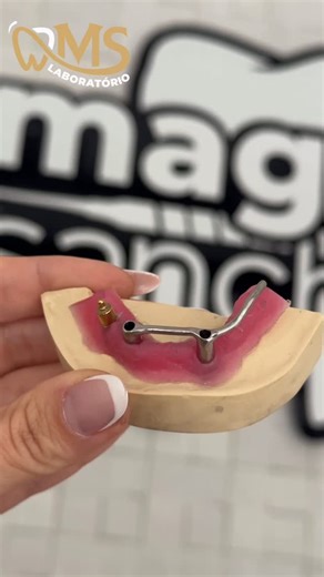 Ms Laboratorio on Instagram: "Barra em titânio para overdenture finalizada! 🤩❤️ 📍 Atendemos todo Brasil! Unidades físicas: São Paulo – SP São Pedro da Aldeia - RJ Para maiores informacoes entre em contato pelo link da bio do @mslaboratorioms 🤩"