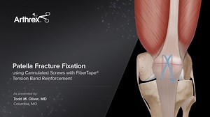 Patella Fracture Fixation Using Cannulated Screws with FiberTape® Tension Band Reinforcement