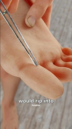 how to remove splincter using a syringe #science #doctor