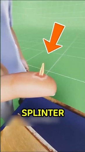 Stuck Splinter? DON'T Use Tweezers First!