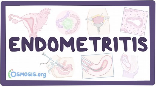 Endometritis: Video, Causes, & Meaning | Osmosis