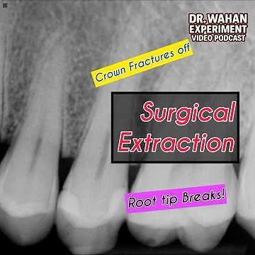 Surgical Premolar Extraction with Dr. Wahan