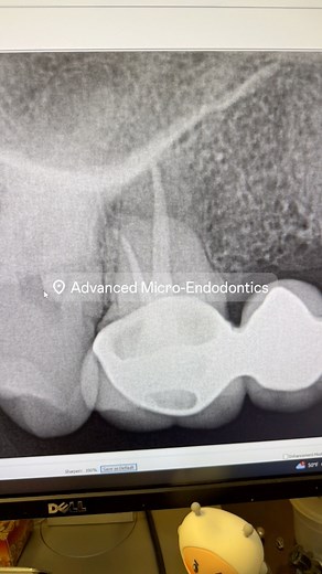16K views · 113 reactions | Don’t do this! #dentistry #dentalschool #hygienists #Dentists #rootcanaltherapy | Advanced Micro-Endodontics | Facebook