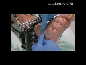 Providing skeletal traction and Pin site care