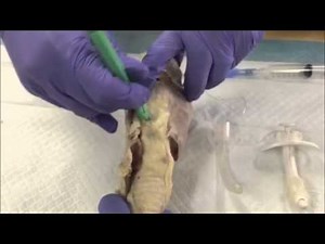 Rapid 4 Step Cricothyrotomy