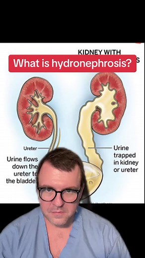 Understanding Hydronephrosis: Causes, Symptoms & Treatments