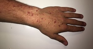 Giant hogweed warning as doctor explains 'nasty' poison of 'boogeyman' plant