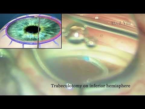 OMNI Glaucoma Surgery