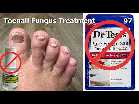 Toenail Fungus