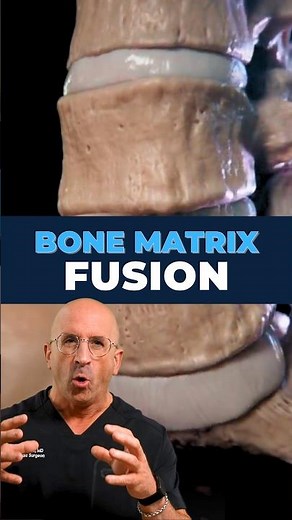 How Bone Graft Actually Fuses the Spine
