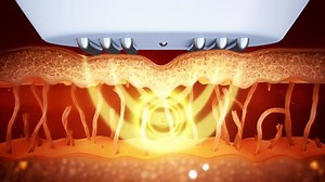 3DEEP™ targeted skin therapy implements the interaction of multiple energy sources for controlled delivery of energy to the dermis and hypodermis. The unique energy delivery mode minimizes the risk to the skin surface or surrounding tissue for an optimal aesthetic result. Selective phase-controlled heat delivery to the collagen fibers results in an immediate skin tightening followed by a second stage of collagen remodeling for anti-wrinkle effect. | EndyMed USA