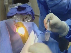 Introduction of the Visian ICL Preloaded Lens - Eyetube