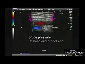 Heel and toe method Doppler ultrasound video