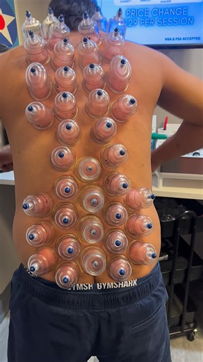6.9K views · 747 reactions |  Cupping therapy uses suction to lift and decompress layers of fascia and muscle, helping improve blood flow, reduce stiffness, and ease deep muscle tension. Great for recovery and stress relief—sometimes you need to pull to release. #CuppingTherapy #MyofascialRelease #SportsRecovery #ChicagoChiropractic #ChiropracticCare #drkyleross | Dr_kyleross | Facebook