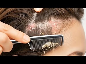 Amazing Scalp Transformation: From Dry & Flaky to Healthy & Clean