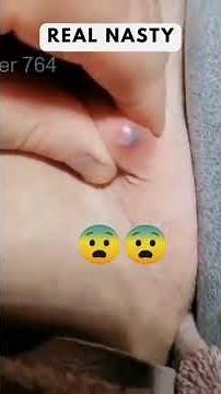 Removing large blackheads and pimples from face new 2026 #166