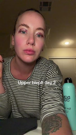 Morning update after my upper bleph swelling’s settling, healing’s happening, and I’m feeling better every hour. Rest, ice, and red light are my entire vibe today. #upperbleph #blepharoplasty #healingjourney #postoprecovery #selfcarevibe