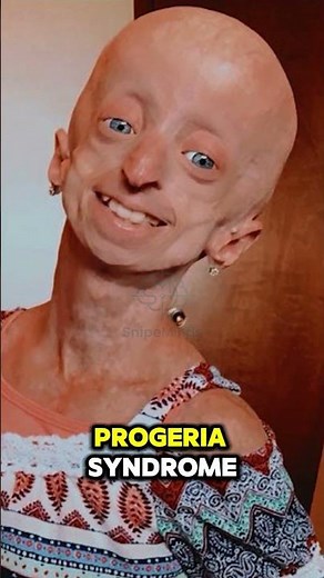 The World's Rarest Aging Disease? 😲 Progeria Syndrome Explained