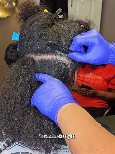 Understanding Seborrheic Dermatitis