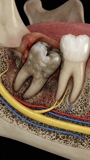 Surgical Extraction of Impacted Tooth: Step-by-Step Guide