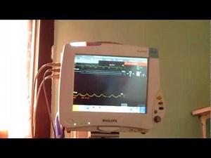 ICU Monitor for a dead person Nablus, it was sad that he didn't make it!!