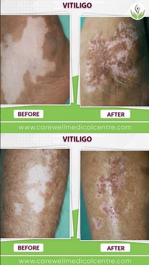 80-90% Vitiligo Recovery in 1 Month | Happy Patient Result | Vitiligo Before & After Treatment