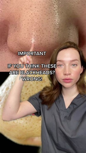 Sebaceous Filaments vs. Blackheads: Spotting the Differences