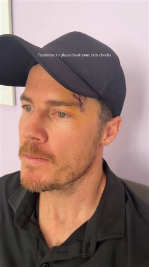 Carmen McNamara on Instagram: "Please book your annual skin check it could save your life.. and therapists if you see something say something.. this was number 4 on my husbands face alone and it’s been uncomfortable and painful 🙏🏼 Once the stitches are out, @dmkskin enzyme therapy and home LED for scar management, plus SPF Betagel etc 🙏🏼🧚 #skincancer #skinfairy #perthskin"