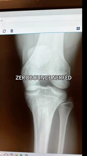 No Doctors Could FIX HIS KNEE!🤯