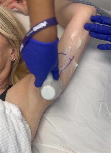 Watch as our body contouring treatment works to target and smooth the upper arm area. The process is comfortable, non-invasive, and designed to gradually sculpt and define! It’s all about precision, care, and helping clients feel their best.  #NuBody #BodyContouring #ArmTreatment #SculptingProcess #NewnanMedSpa | NubodyFace Aesthetics | Facebook