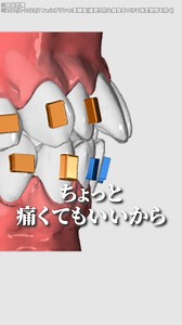 ＼15万円プラン実施中✨／ ✅歯の矯正したいけど金欠... ✅通院するのが面倒... ✅継続できるか不安... そんなあなたにピッタリ！ コスパ良し💵 おうちでできる🏠 マウスピース矯正「Oh my teeth」✨ | Oh my teeth