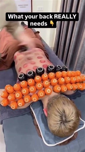 Fire Cupping Therapy| Back Treatment. Deep tissue stimulation using controlled heat & suction.