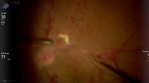 Intravascular Injection of tPA in a Case of CRVO - Eyetube