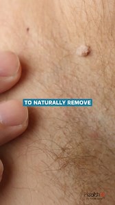 68K views · 140 reactions | Safe and natural skin tag removal tips. #health #skintags #fitness #wellness | Health+ | Facebook