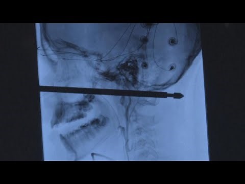 10-Year-Old Missouri Boy Miraculously Survives After He's Impaled by Meat Skewer