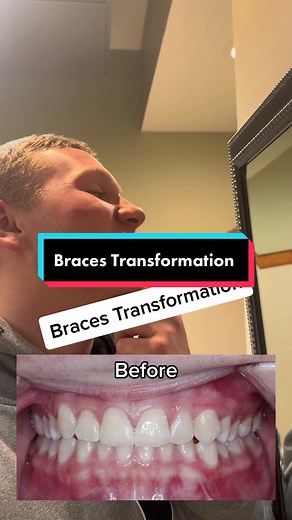 Amazing Braces Transformation Before & After