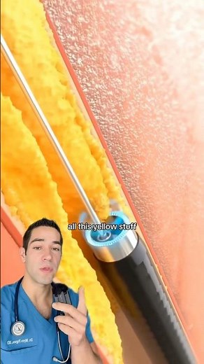 Doctor Explains: inside a leg artery