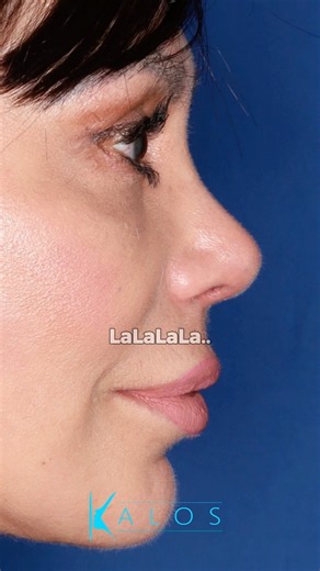 Rhinoplasty + Alar Base Reduction: Creating Better Facial Balance