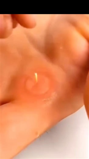 #fyr #splinter #removal #hand #physics #work #peace #tolive #buycanadian