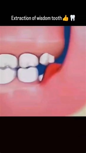 Dental Care Center on Instagram: "🦷 Wisdom Tooth Extraction Pain, swelling, or repeated infection? 😣 Removing the wisdom tooth brings instant relief and protects nearby teeth. A small step today for a pain-free, healthy smile tomorrow ✨ 📍 Dental Care Center Shop No. 4, Second Floor, Mahagun Mart, Sector 78, Noida 📞 9211842776 #WisdomToothExtraction #ToothPainRelief #DentalCare #OralHealth #PainFreeSmile"