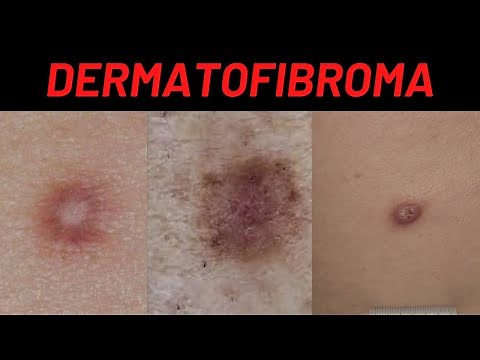 Dermatofibroma Causes, Symptoms, What is it? How is it treated? (Benign Fibrous Histiocytoma)