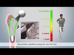 Mathys: optimys – van primaire tot secundaire stabiliteit inclusief de herstelfases